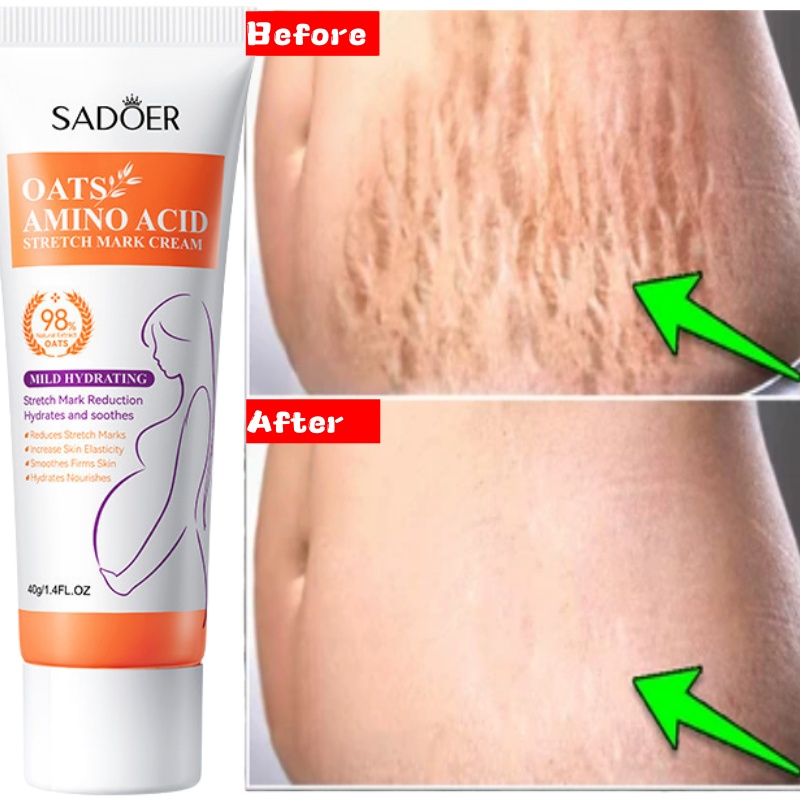 Striae Permanente Verwijdering - Skincare Oat recensie en prijs