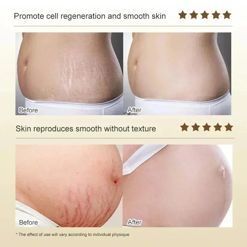 Striae Permanente Verwijdering - Skincare Oat recensie en prijs